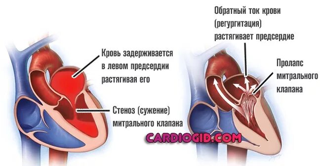 Недостаточность предсердия. Декомпенсированные патологии сердца. Дилатация левого предсердия. Недостаточность левого предсердия. Декомпенсация левого предсердия.