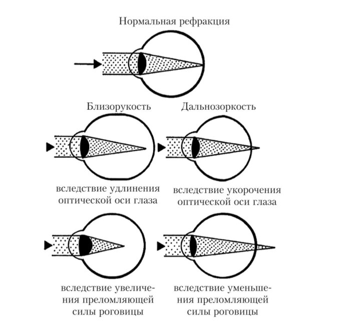 Варианты нарушения зрения
