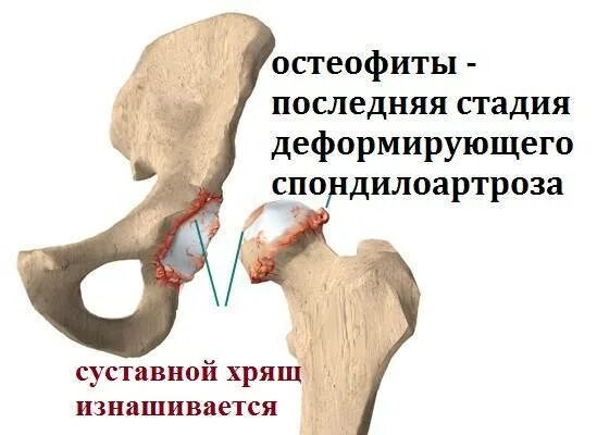 Остеофиты что это такое и как лечить. Остеофит бедренной кости. Остеофиты тазобедренного.