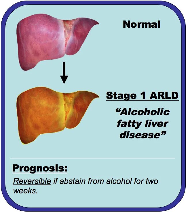 Жировая дистрофия печени. Фиброз гепатоз печени цирроз. Alcoholic disease. Alcoholic disease. Печень здоровая и больная.