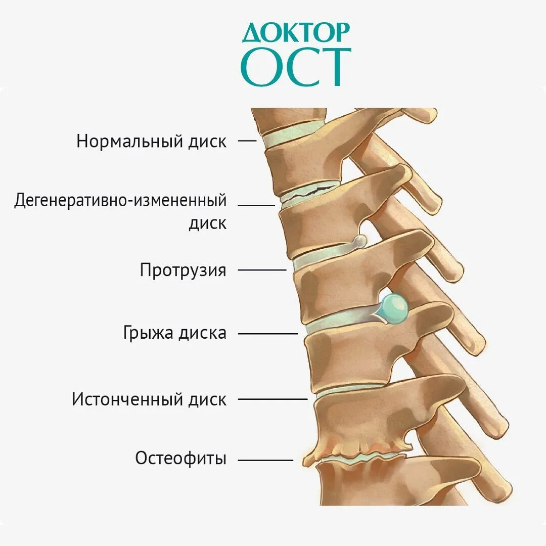 Протрузия шейного отдела на мрт. Остеохондроз протрузии и грыжи позвоночника. Межпозвонковые диски l5-s1. Протрузии дисков 4 7. Протрузии диска с3/4.