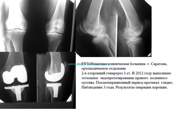 Форум после эндопротезирования коленного сустава. Гонартроз эндопротезирование коленного сустава. протокол операции эндопротезирование коленного сустава. снимок коленных суставов к операции. спо тотальное эндопротезирование коленного сустава рентген.