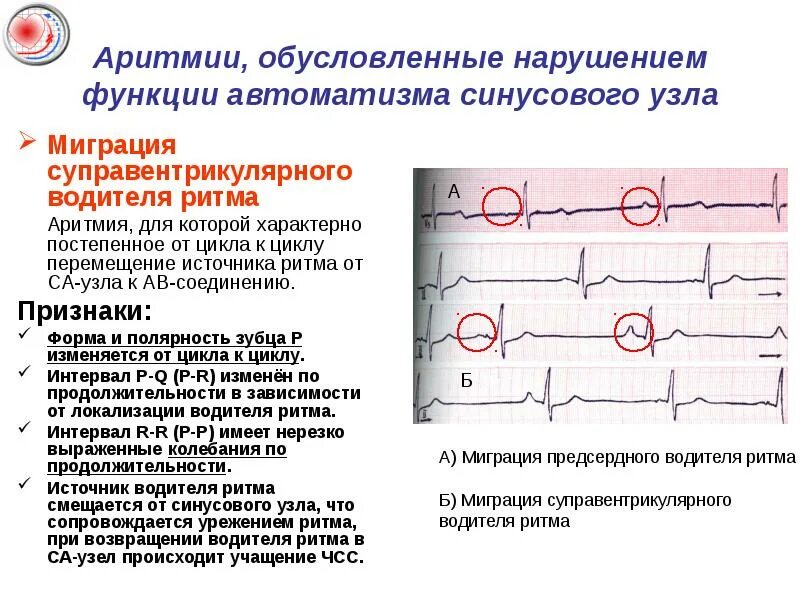 Суправентрикулярная миграция. Миграция предсердного водителя ритма на экг. Миграция наджелудочкового водителя ритма. Миграция предсердного водителя ритма на экг. Суправентрикулярные ритмы.