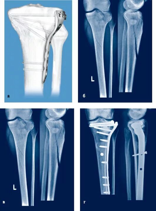 Латерального мыщелка большеберцовой кости. Остеосинтез латерального мыщелка большеберцовой кости. Остеосинтез переломов мыщелков большеберцовой кости. Хондральный перелом мыщелка большеберцовой кости. Импрессионный перелом мыщелков большеберцовой кости.