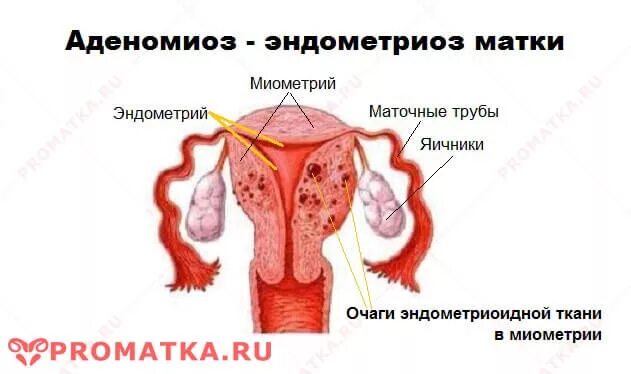 Внутренний эндометриоз матки. Ткани эндометрия матки. Эндометриоз аденомиоз матки. Гиперплазия эндометрия аденомиоз.