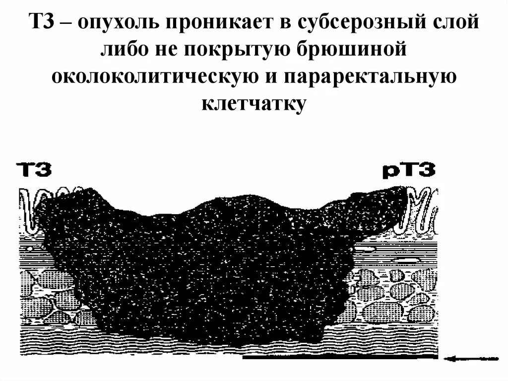 Паравезикальная клетчатка. Субсерозный слой желудка. Субсерозный слой кишки это. Желудок субсерозная оболочка четвертый слой описание и рисунок.