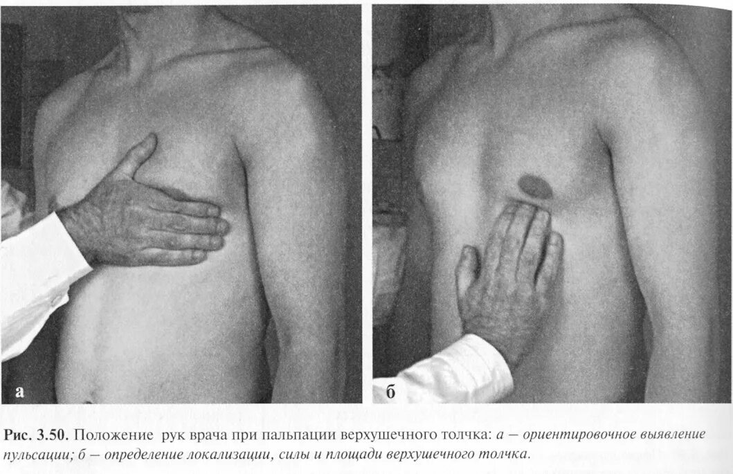 Верхушечный толчок при гипертрофии. Осмотр и пальпация области сердца верхушечный толчок. пальпация грудной клетки патологии. пальпация области сердца пропедевтика. пальпация верхушечного толчка в норме.