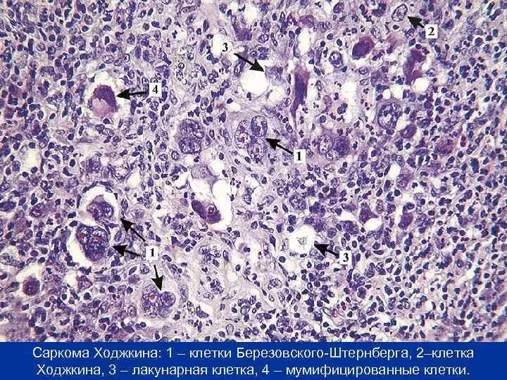 Лимфома лимфатические узлы. Лимфогранулематоз гистология клетки Березовского Штернберга. Клетки Березовского-Штернберга гистология. Лимфома Ходжкина клетки Березовского-Штернберга-Рид. Лимфома Ходжкина гистология.