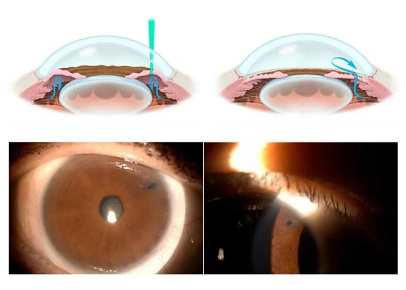 Операция лазерная иридэктомия. Периферическая лазерная иридотомия. Лазерная иридотомия при глаукоме. Лазерная периферическая иридэктомия (глаукома). Когда можно мыть голову после катаракты
