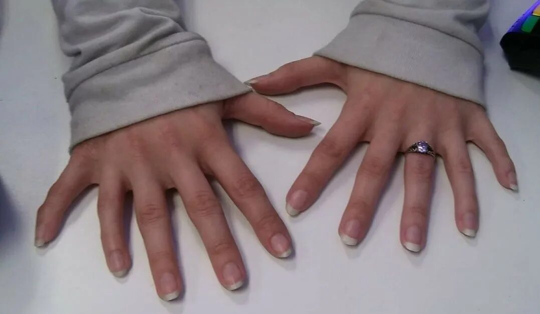На 1 руке 6 пальцев. Полидактилия Эрнандес Гарридо. Полидактилия генная мутация.