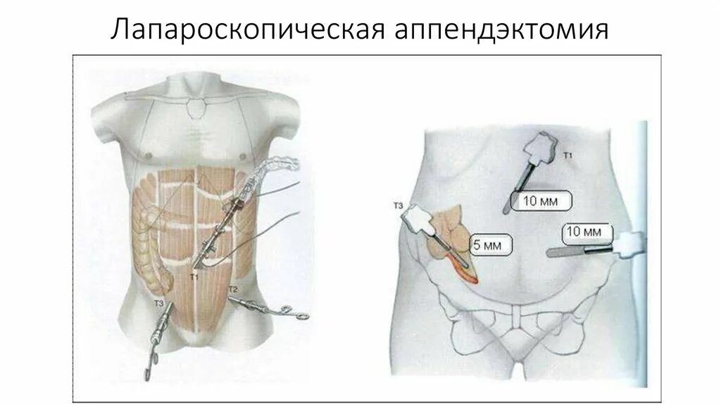 Аппендицит сколько в больнице после операции. Операция лапароскопия аппендэктомия. Эндоскопическая аппендэктомия. Операция аппендикс лапароскопическая аппендэктомия. Видеолапароскопическая аппендэктомия.