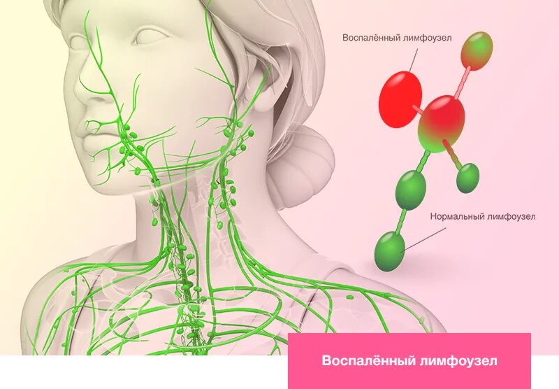 Лимфоотток в организме. Лимфатическая система лимфоузлы. Воспаление лимфоузлы воспаление. Лимфатическая система человека схема на лице. Воспаленные лимфоузел.