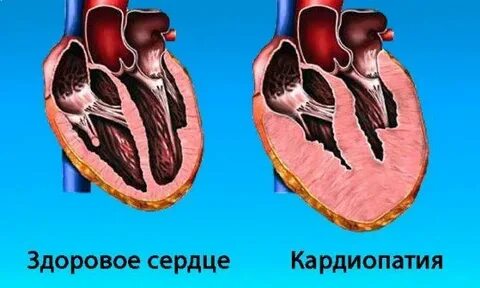 Кардиомиопатия симптомы причины