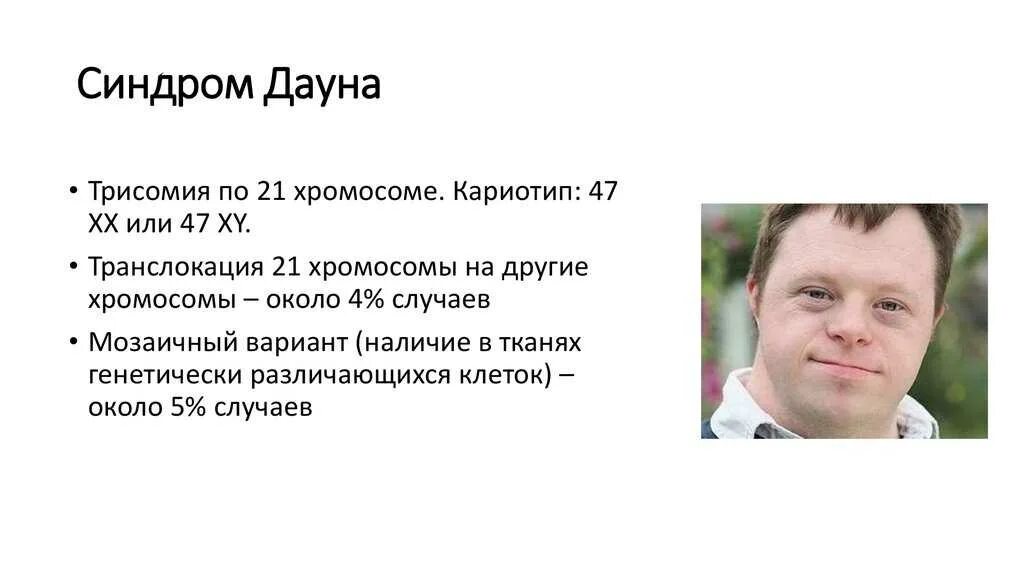 Синдром Дауна трисомия по 21 хромосоме. Синдром Дауна (трисомия по 21 паре хромосом) клиника. Синдром Дауна (трисомия по 21 паре хромосом). Синдром Дауна 47 хромосом. Варианты синдрома дауна