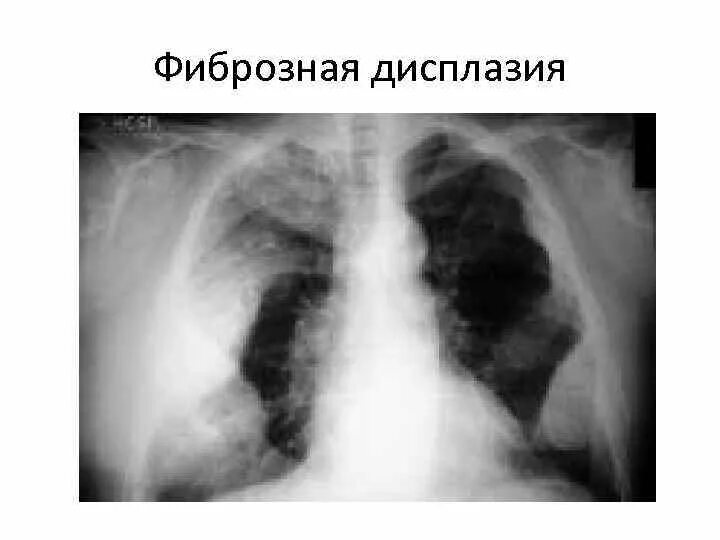 Очаг фиброзной дисплазии кт. Фиброзная остеодисплазия кт. Фиброзная дисплазия костей на кт. Фиброзная дисплазия ребра рентген. Фиброзная дисплазия грудины.