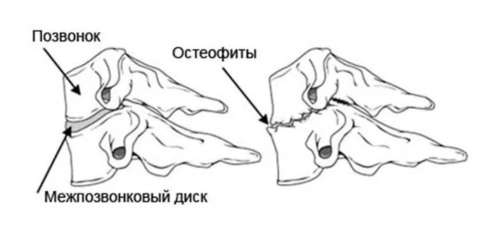 Остеофиты что это такое и как лечить. Переднебоковые остеофиты. Остеофиты позвоночника. Краевые остеофиты на l4.