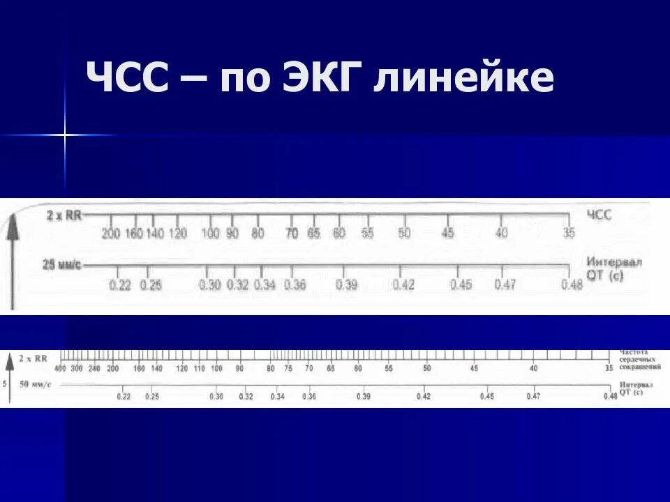 Чсс по экг 25. Линейка экг. чсс по экг. линейка чсс. линейка для расчета экг.