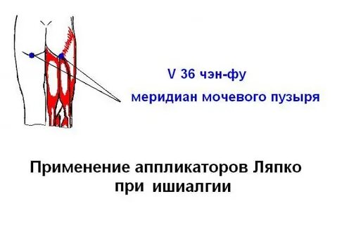 Аппликатор седалищный нерв