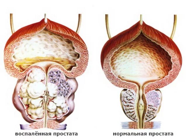 Хроническая простата аденома. Аденома предстательной железы. Кальциноз предстательной железы.