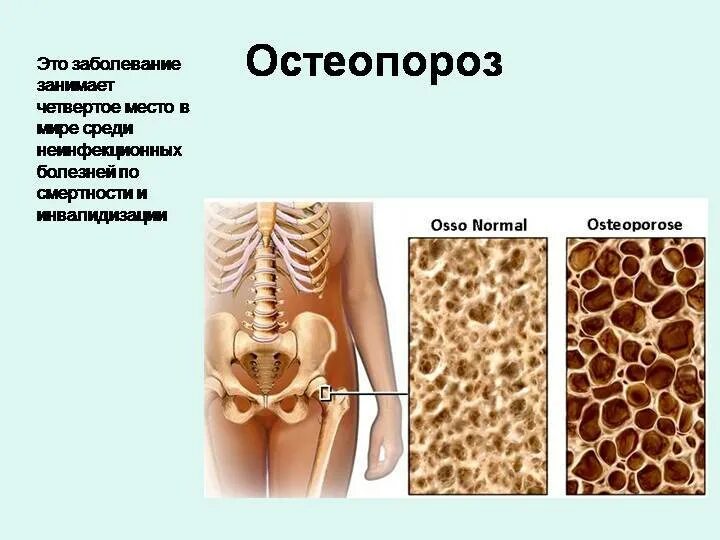 Остеопороз у молодых. Остеопороз у молодых