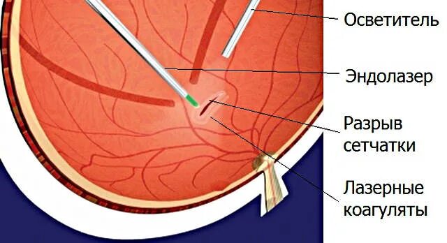 Барьерная лазеркоагуляция сетчатки. Эндолазерная коагуляция. Отграничительная лазеркоагуляция сетчатки глаз. Панретинальная лазерная коагуляция.