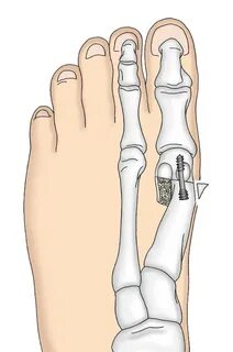 Hallux valgus что это такое