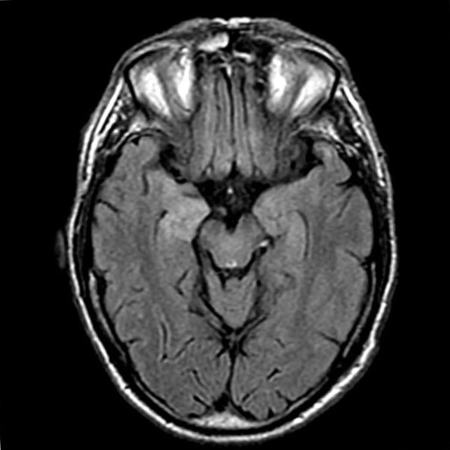 Лейкоэнцефалит