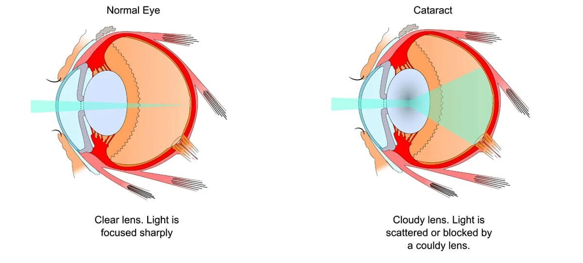 Катаракта схема глаза. Патология хрусталика (катаракта). Катаракта глаза катаракта схема. Схема хрусталика глаза. Нормальный глаз схема