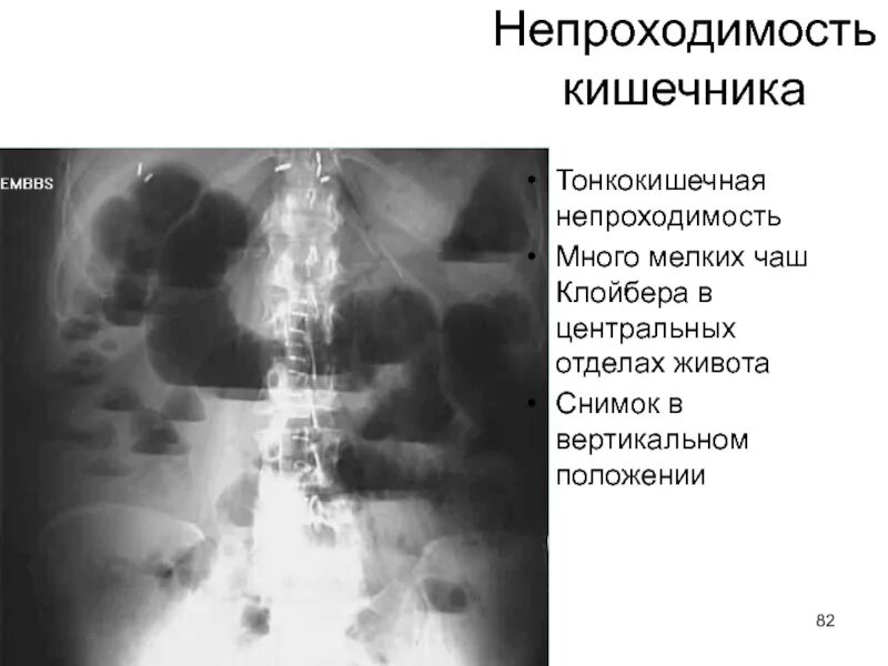 Кишечная непроходимость рентген латеропозиция. Рентген брюшной полости кишечная непроходимость. Кишечная непроходимость рентген тонкокишечная. Газ в тонкой кишке. Рентген контрастирование кишечника.