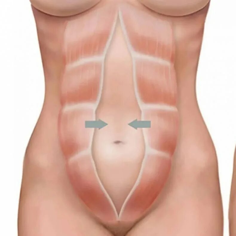Диастаз прямой мышцы живота. Мышцы живота анатомия диастаз. Диастаз брюшной стенки. Диастаз (расхождение краев прямой мышцы живота),.