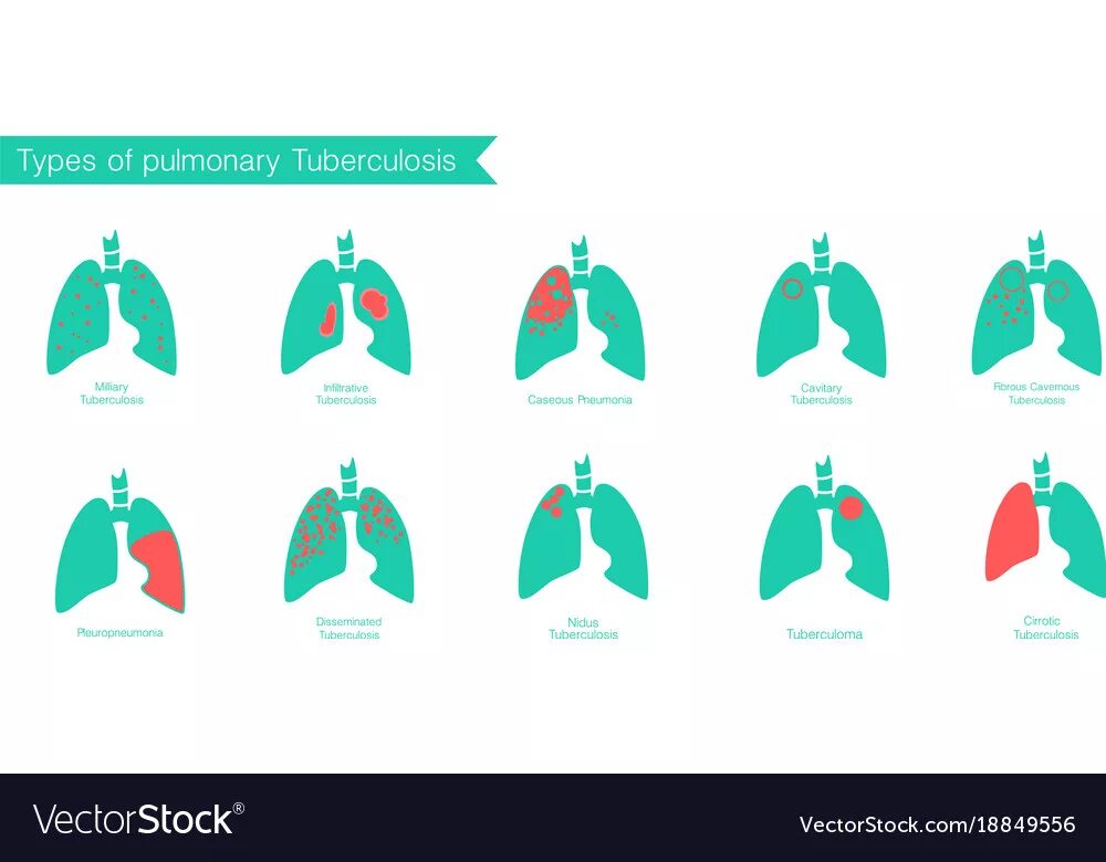 Туберкулез Векторная Графика. Туберкулез Векторная картинка. Туберкулез инфографика. Полость заболевания легких
