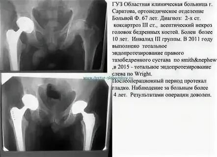 Инвалидность при замене двух тазобедренных суставов