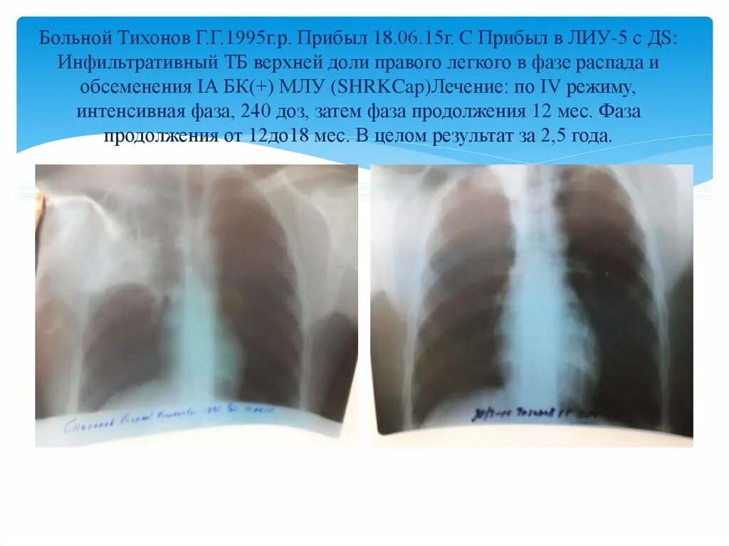 Фиброз в доле легкого. Фаза инфильтрации распада обсеменения. Инфильтративный туберкулез фаза обсеменения. Фиброателектаз средней доли правого легкого. Фаза обсеменения при туберкулезе.