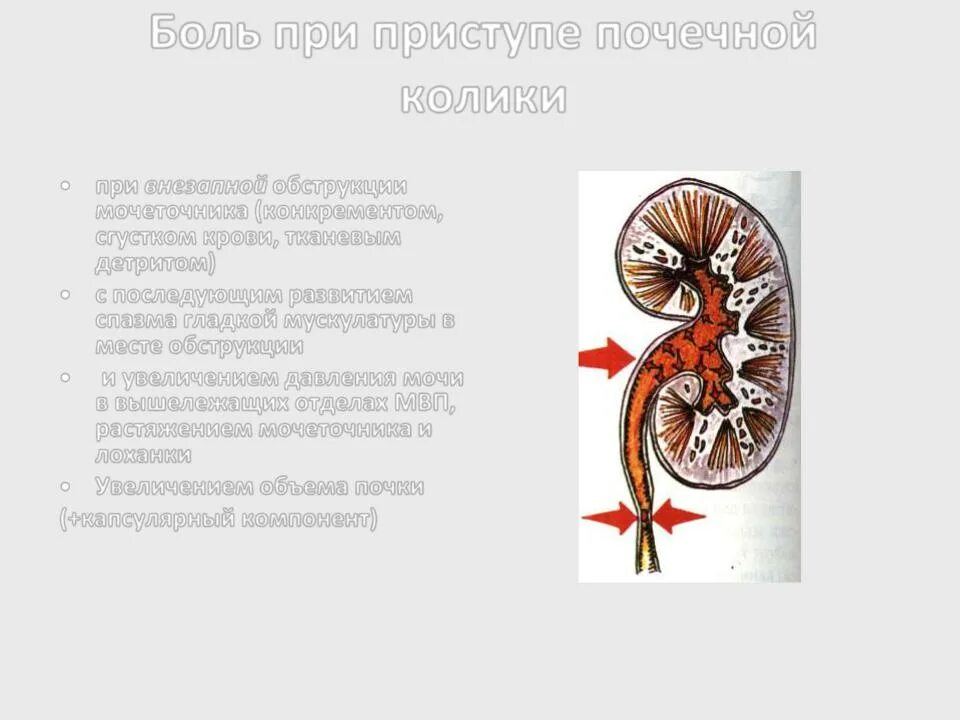 Обструкция мочеточника. Увеличение лоханки почки. Почечная лоханка и мочеточник. Обтурация мочеточника.