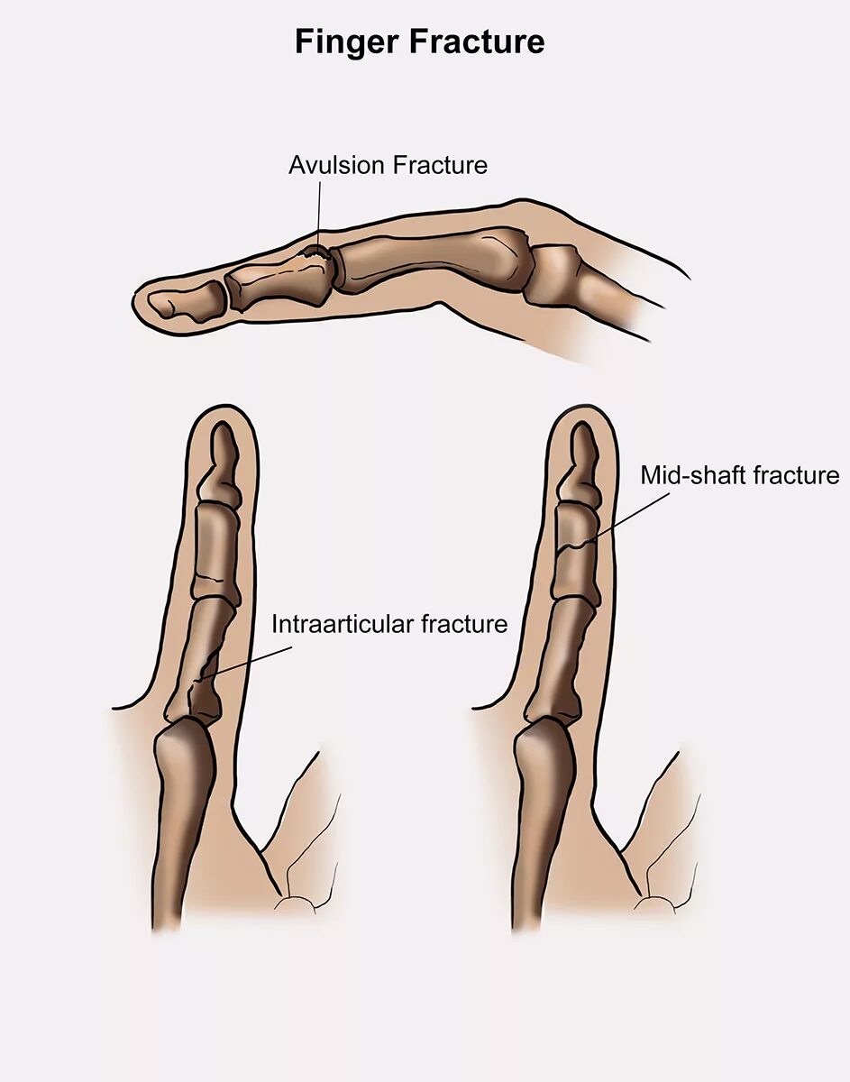 Трещина кости большого пальца. Трещина кости на пальце руки. Как понять что у тебя трещина