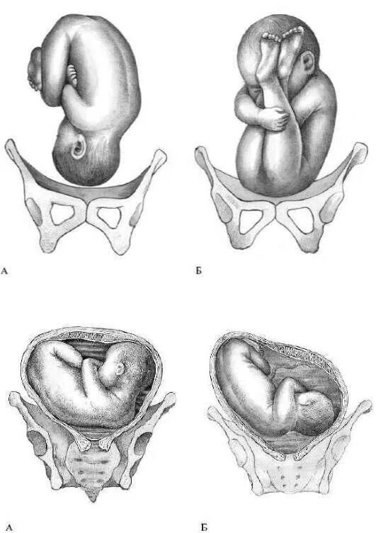 Правильное предлежание. Поперечно ягодичное предлежание плода. Продольное положение плода. Поперечное предлежание плода 2 позиция. Ягодичное предлежание 2 позиция.