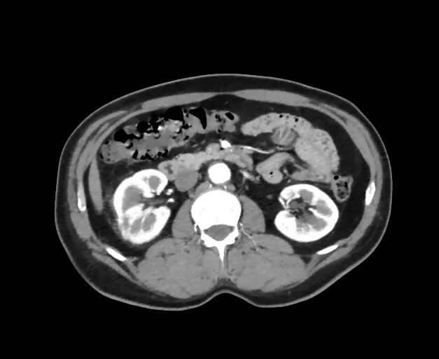 The Radiology Assistant : Solid Renal Masses