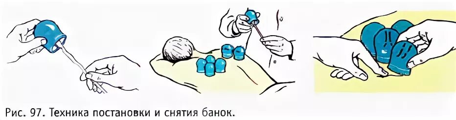 При каком кашле можно ставить банки