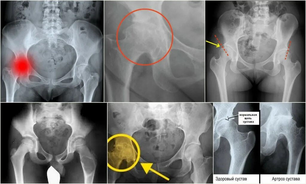 Коксартроз 2 степени рентген. Коксартроз тазобедренного сустава рентген. Коксартроз тазобедренного сустава 2 степени на рентгене. Остеоартрит тазобедренного сустава рентген. Артрит артроз тазобедренных суставов