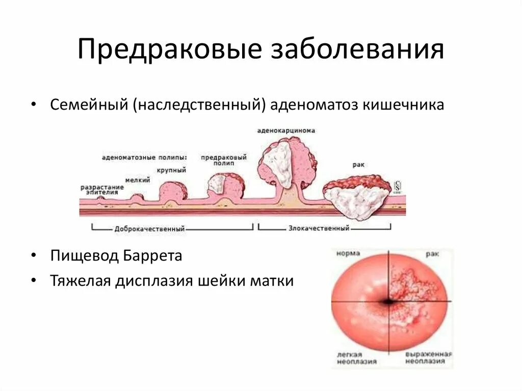 Наличия дисплазии. Дисплазия предраковые заболевания. Дисплазия тяжелой степени предрак?. Предраковые заболевания шейки матки. Дисплазия шейки матки - это предраковое заболевание!.