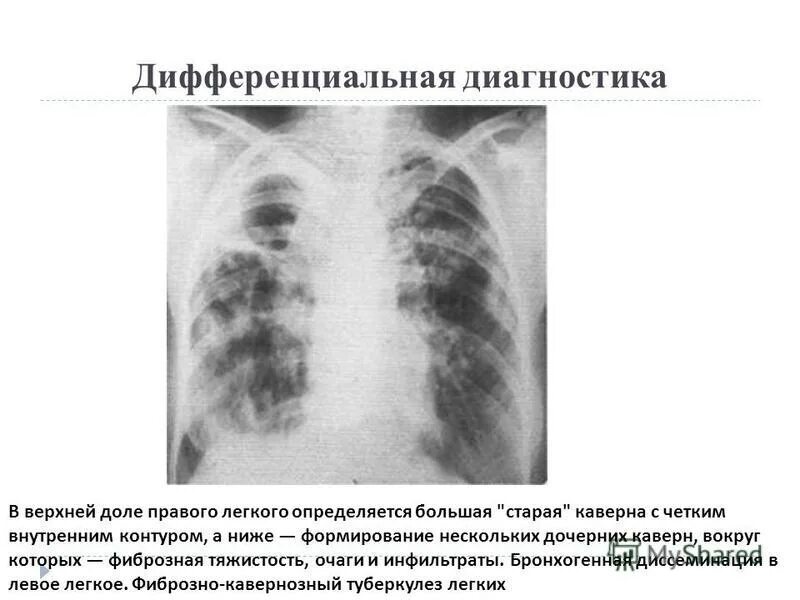 Кавернозный туберкулез верхней доли правого легкого. Фиброзно-кавернозный туберкулез. Фиброзно-кавернозный туберкулез легких диагностика. Фиброзно-кавернозный туберкулез рентген.