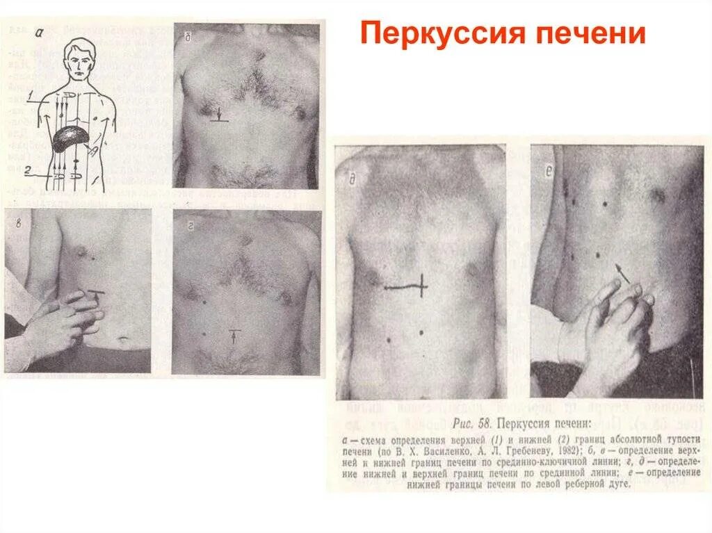 Печень по курлову у детей. Техника перкуссии печени по курлову. Перкуссия печени Курлов. Границы печени перкуссия. Перкуссия печени по курлову алгоритм.