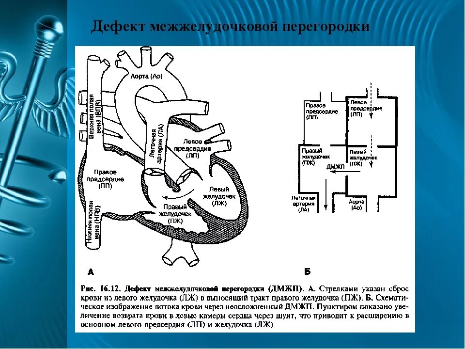 Дефект межжелудочковой перегородки схема. Дефект межпредсердной перегородки гемодинамика схема. Дефект межжелудочковой перегородки (ДМЖП). ДМЖП гемодинамика у детей. Гемодинамика у детей