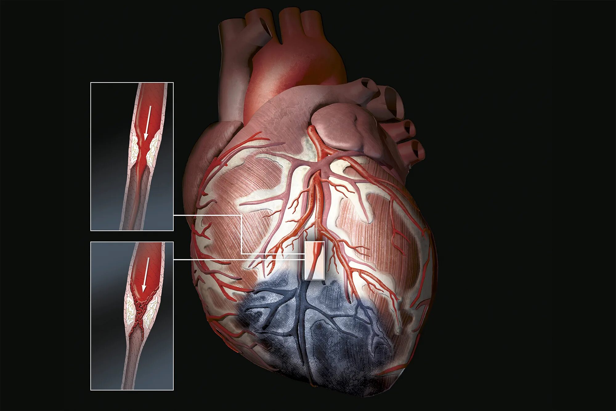 Ишемический инфаркт сердца. Ишемия инфаркт миокарда. Сердце при инфаркте миокарда.