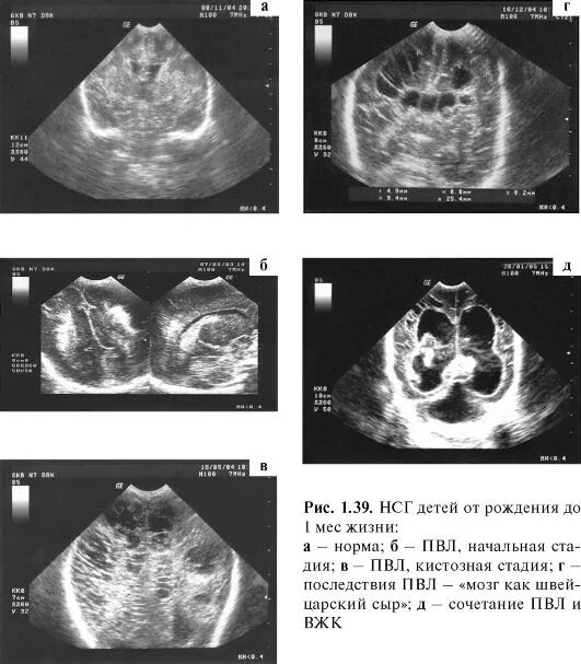 Нсг мозга. Перивентрикулярная лейкомаляция НСГ. Нейросонография желудочки. Кисты НСГ УЗД. УЗИ НСГ У новорожденных норма.