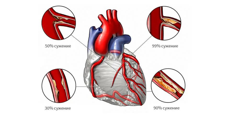 Чем опасна ишемия. Осложнения ишемической болезни. Проявления ишемической болезни сердца. Ишемическая болезнь сердца (ИБС).