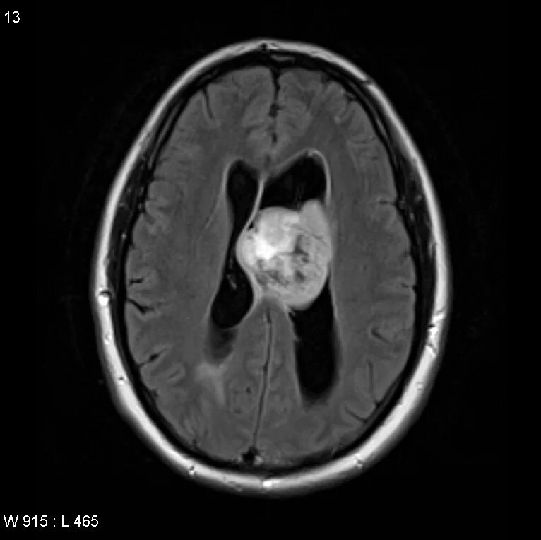 Эпендимома 4 желудочка головного мозга мрт. Опухоль 3 желудочка головного мозга. Опухоли боковых желудочков головного мозга.