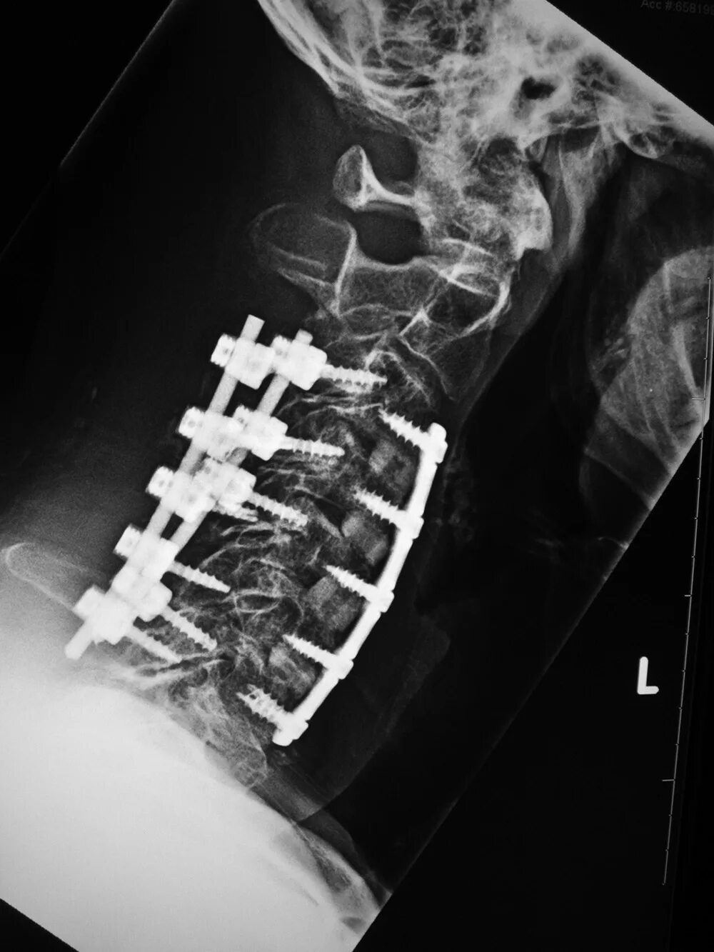 Передний спондилодез l5. Остеосинтез позвоночника рентген. Перелом позвоночника остеосинтез рентген. Спондилодез шейного отдела рентген. Реабилитация после операции на позвоночнике с металлоконструкций