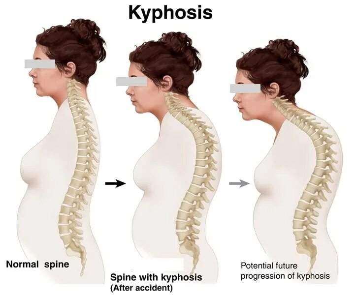 Лордоз грудного отдела. Лордоз грудного отдела кифоз поясничного. Кифосколиоз лордоз грудного отдела позвоночника. Позвоночник человека лордоз кифоз. Лордоз грудного отдела кифоз поясничного.