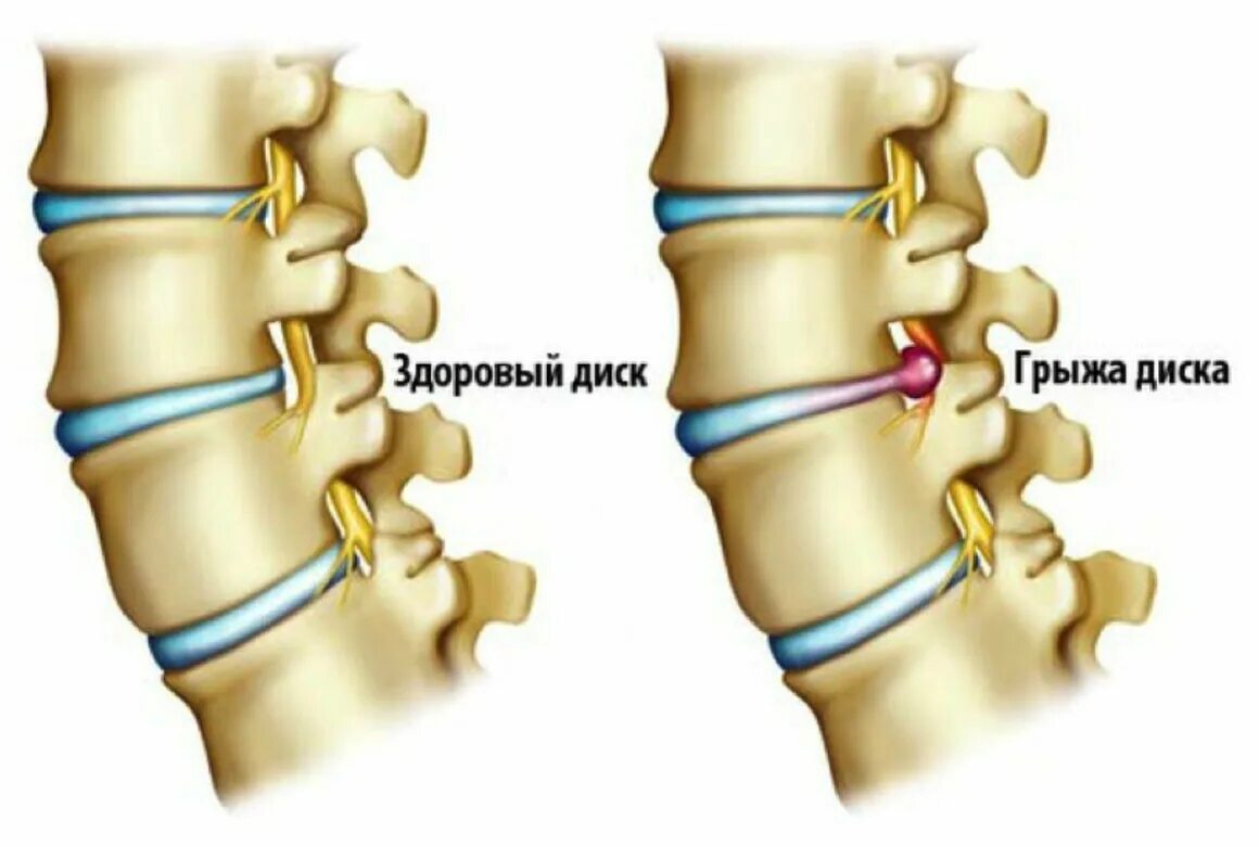 Симптомы межпозвоночной грыжи. Междисковая грыжа позвоночника. Грыжа диска позвоночника поясничного отдела. Межпозвонковая грыжа крестцового отдела. Междисковая грыжа поясничного отдела.